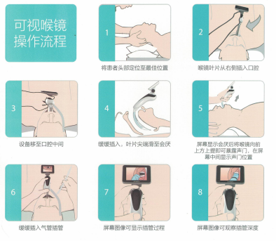 可視喉鏡 可視喉鏡